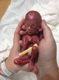 aborted-fetus.jpg